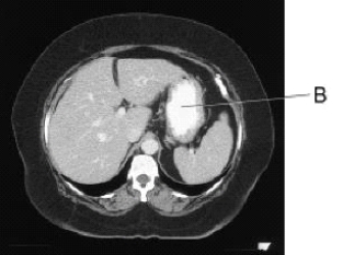Line B on this image is pointing to the:   A)  liver. B)  stomach. C)  spleen. D)  small bowel.