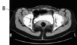 Line B on this CT scan is pointing to the:   A)  uterus. B)  rectum. C)  bladder. D)  small bowel.