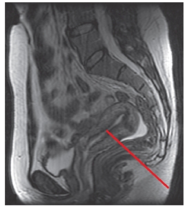 <strong>The line on this image labels the: </strong> A) uterine cavity. B) urinary bladder. C) rectum. D) kidney.