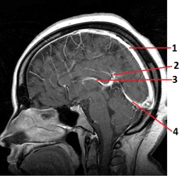 Which number labels the straight sinus in this image?   A)  1 B)  2 C)  3 D)  4