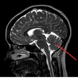 The line on the image below points to the:   A)  occipital lobe. B)  temporal lobe. C)  pons. D)  cerebellum.
