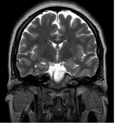 What imaging plane is demonstrated in this image?   A)  Sagittal B)  Coronal C)  Axial D)  Oblique