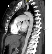 On the image below,the line points to the:   A)  spinal cord. B)  ascending aorta. C)  descending aorta. D)  abdominal aorta.
