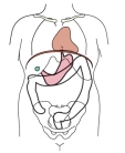 Which body habitus is shown in this figure?   A)  Hypersthenic B)  Hyposthenic C)  Asthenic D)  Atrophic