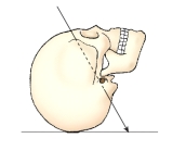 The x-ray projection identified in this figure is:   A)  AP. B)  PA. C)  AP axial. D)  AP oblique.