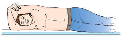 What is the patient position illustrated in this figure?   A)  Dorsal recumbent B)  Right lateral recumbent C)  Left lateral decubitus D)  Trendelenburg