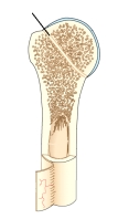 The area of the bone indicated by the line on this figure is the:   A)  periosteum. B)  endosteum. C)  compact bone. D)  epiphyseal line.