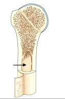 The area of the bone indicated by the arrow on this figure is the:   A)  spongy bone. B)  compact bone. C)  medullary cavity. D)  medullary Cavity.