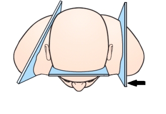 The plane indicated by the arrow in this figure is the:   A)  sagittal. B)  coronal. C)  oblique. D)  horizontal.