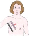 The projection of the breast shown in the figure below is a:   A)  mediolateral (ML) . B)  lateromedial (LM) . C)  mediolateral oblique (MLO) . D)  lateromedial oblique (LMO) .