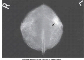 The arrow in the images below points to a mass with the characteristics of a:   A)  benign tumor. B)  malignant tumor. C)  fibrous tissue mass. D)  cystic lesion.