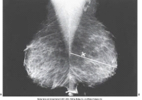 The white line,labeled as X in the images below is the _____ line.   A)  posterior nipple B)  pectoralis muscle C)  breast width D)  breast length