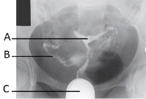 What reproductive system procedure is demonstrated in the image below?   A)  Hysterosalpingogram B)  Vaginography C)  Vesiculography D)  Pelvimetry
