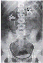 The dilated,proximal portion of the ureter is labeled with an arrow.What is the name of this anatomy shown in the image from an IVU below?   A)  Renal pelvis B)  Hilum C)  Calyx D)  Trigone