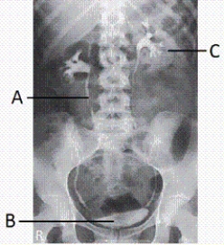 What anatomy is labeled with the letter A shown in the image from an IVU examination below?   A)  Left ureter B)  Right ureter C)  Left renal pelvis D)  Right renal pelvis