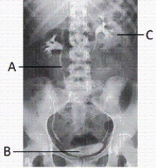 What anatomy is indicated by letter C in the image below?   A)  Left kidney B)  Right kidney C)  Right renal pelvis D)  Left renal pelvis