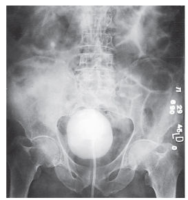What is the projection and procedure demonstrated in this image?   A)  AP,IVU B)  AP,cystogram C)  PA,retrogram urogram D)  AP oblique,IVU