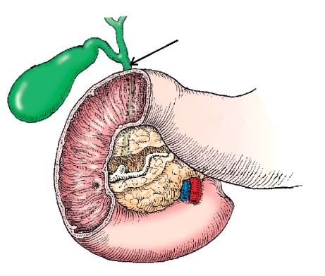 The anatomy labeled with the arrow in this figure is the:   A)  cystic duct. B)  common hepatic duct. C)  common bile duct. D)  pancreatic duct.