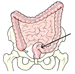 The area of the colon identified in the figure below is the:   A)  cecum. B)  ileum. C)  rectum. D)  sigmoid.