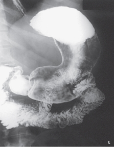 Which projection of the stomach is demonstrated in this figure?   A)  PA B)  PA oblique C)  AP oblique D)  Lateral