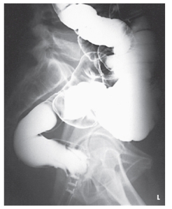 What anatomy is best demonstrated in this image?   A)  Sigmoid B)  Ascending colon C)  Rectum D)  Descending colon