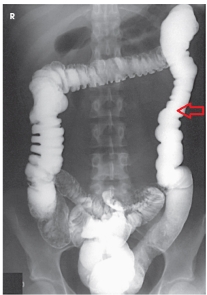 What anatomy is labeled with the arrow in this image?   A)  Cecum B)  Ascending colon C)  Descending colon D)  Sigmoid