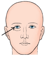 The external landmark identified in the figure below is the:   A)  glabella. B)  acanthion. C)  outer canthus. D)  infraorbital margin.