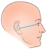 The topographic line shown in the figure below is the:   A)  glabellomeatal. B)  orbitomeatal. C)  acanthiomeatal. D)  infraorbitomeatal.