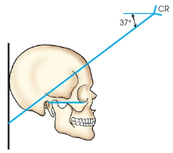 Which method of examining the skull is identified in the figure below?   A)  Haas B)  Towne C)  Shüller D)  Caldwell