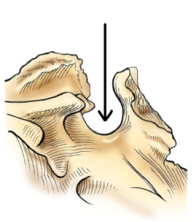 The part of the sphenoid bone identified in the figure below is the:   A)  clivus. B)  foramen magnum. C)  sella turcica. D)  dorsum sellae.