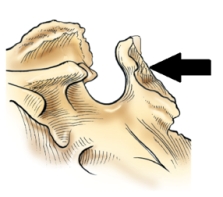 The part of the sphenoid bone identified in the figure below is the:   A)  clivus. B)  clinoid processes. C)  sella turcica. D)  dorsum sellae.