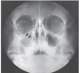 What is the projection (method) demonstrated in the image below used to evaluate trauma to the orbit?   A)  Parietoacanthial (Waters)  B)  PA axial (Caldwell)  C)  AP axial (Towne)  D)  PA axial (Haas) 