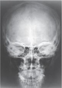 What projection (method) used to evaluate the cranium is demonstrated in the image below?   A)  Parietoacanthial (Waters)  B)  PA axial (Caldwell)  C)  AP axial (Towne)  D)  PA