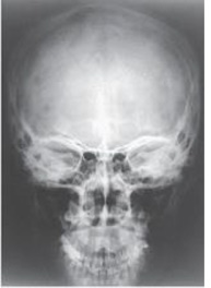 How was the central ray directed to obtain the image below,used to evaluate the cranium?   A)  Perpendicular B)  15 degrees caudad C)  15 degrees cephalad D)  37 degrees caudad