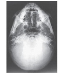 What projection (method) is demonstrated in the image below,used to evaluate the cranium?   A)  PA axial (Caldwell)  B)  AP axial (Towne)  C)  PA axial (Haas)  D)  SMV (Shüller) 