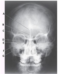 What projection (method) is demonstrated in the image below,used to evaluate the cranium?   A)  PA axial (Caldwell)  B)  AP axial (Towne)  C)  PA axial (Haas)  D)  SMV (Shüller) 