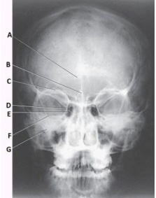 What structure is labeled as letter B in the image below,used to evaluate the cranium?   A)  Acanthion B)  Crista galli C)  Cribriform plate D)  Petrous ridge
