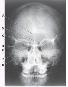 Letter F in the image below used to evaluate the cranium labels the:   A)  ethmoid sinuses. B)  crista galli. C)  petrous ridge. D)  inferior orbital margin.