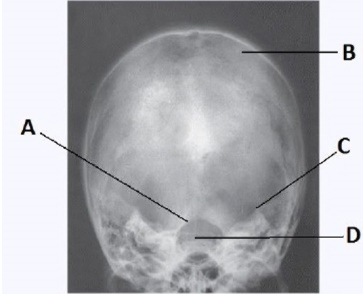 What projection (method) is demonstrated in the image below,used to evaluate the cranium?   A)  PA B)  AP axial (Towne)  C)  PA axial (Caldwell)  D)  SMV (Schüller) 