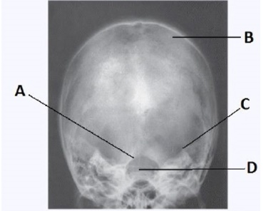 Letter A in the image below,used to evaluate the cranium,labels the:   A)  dorsum sella. B)  foramen magnum. C)  petrous ridge. D)  parietal bone.