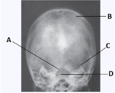Letter B in the image below,used to evaluate the cranium,labels the:   A)  dorsum sella. B)  foramen magnum. C)  petrous ridge. D)  parietal bone.
