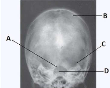 Letter C in the image below,used to evaluate the cranium,labels the:   A)  dorsum sella. B)  foramen magnum. C)  petrous ridge. D)  parietal bone.
