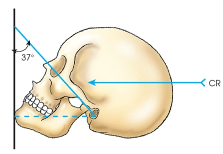 The figure below demonstrates the _____ method.   A)  Haas B)  Stenvers C)  Waters D)  reverse Waters