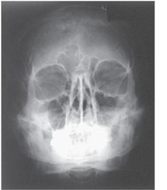 What projection (method) of the facial bones is demonstrated in the image below?   A)  AP axial (Towne)  B)  Parietoacanthial (Waters)  C)  Parietoacanthial (modified Waters)  D)  PA axial (Caldwell) 