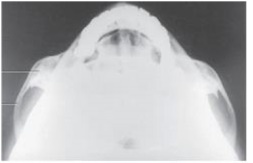 What projection and anatomy is demonstrated in the image below?   A)  SMV of the TMJs B)  SMV of the zygomatic arches C)  AP axial of the TMJs D)  AP axial of the zygomatic arches
