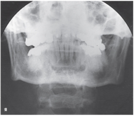 What projection and anatomy is demonstrated in the image below?   A)  AP axial of the TMJs B)  PA axial of the mandibular rami C)  PA of the mandibular body D)  Axiolateral oblique of the mandibular body
