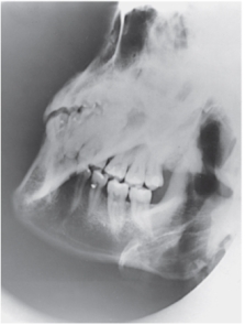 What projection and anatomy is demonstrated in the image below?   A)  AP axial of the TMJs B)  PA axial of the mandibular rami C)  PA of the mandibular body D)  Axiolateral oblique of the mandibular body