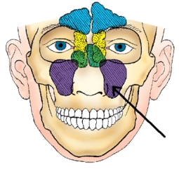 The sinus identified in the figure below is the:   A)  frontal. B)  maxillary. C)  ethmoidal. D)  sphenoidal.