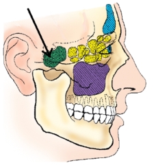 The sinus identified in the figure below is the:   A)  frontal. B)  maxillary. C)  ethmoidal. D)  sphenoidal.