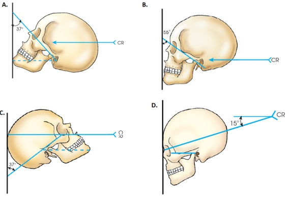 Which drawing in the figure below demonstrates the correct head position for the Waters method?   A)  A B)  B C)  C D)  D
